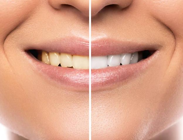 Aparato blanqueador de dientes